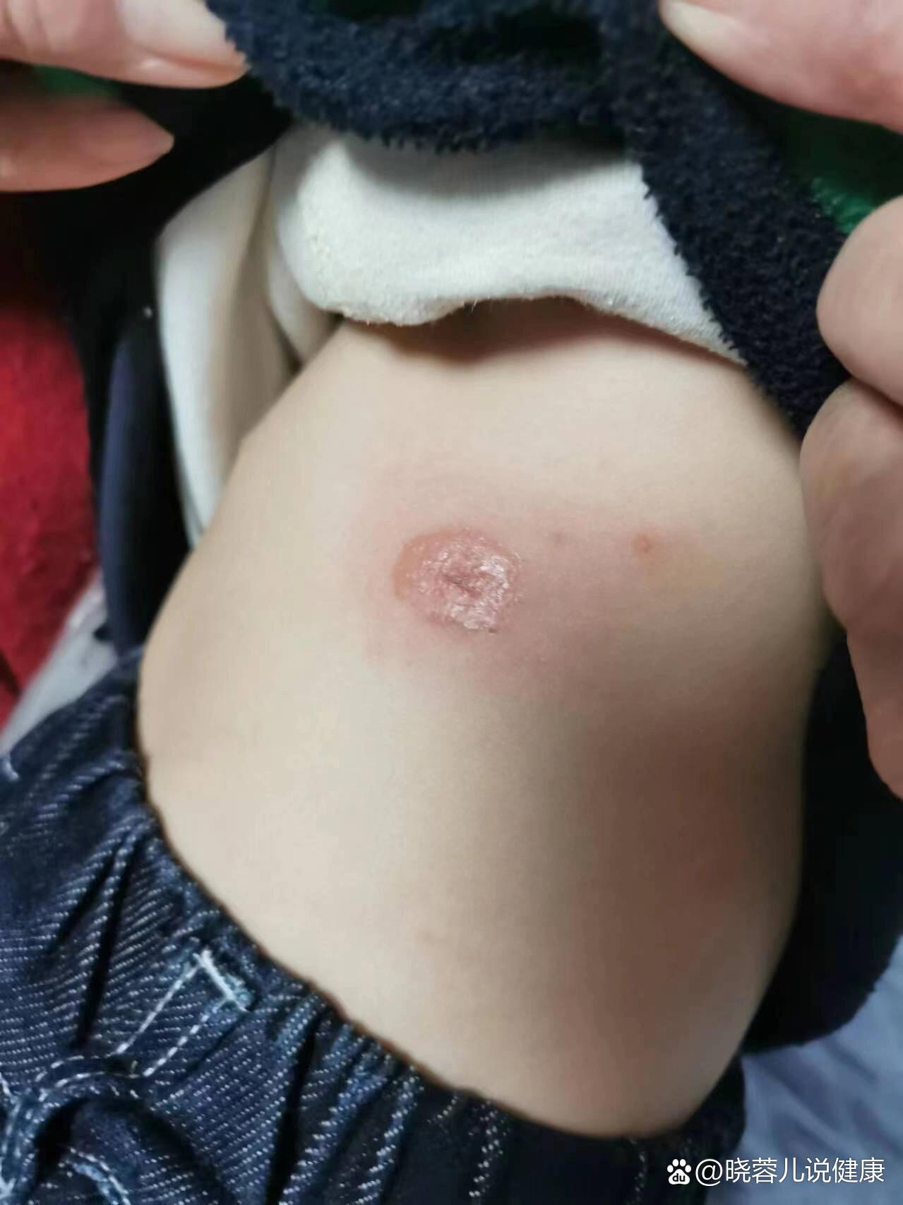 黄水疮是怎么回事