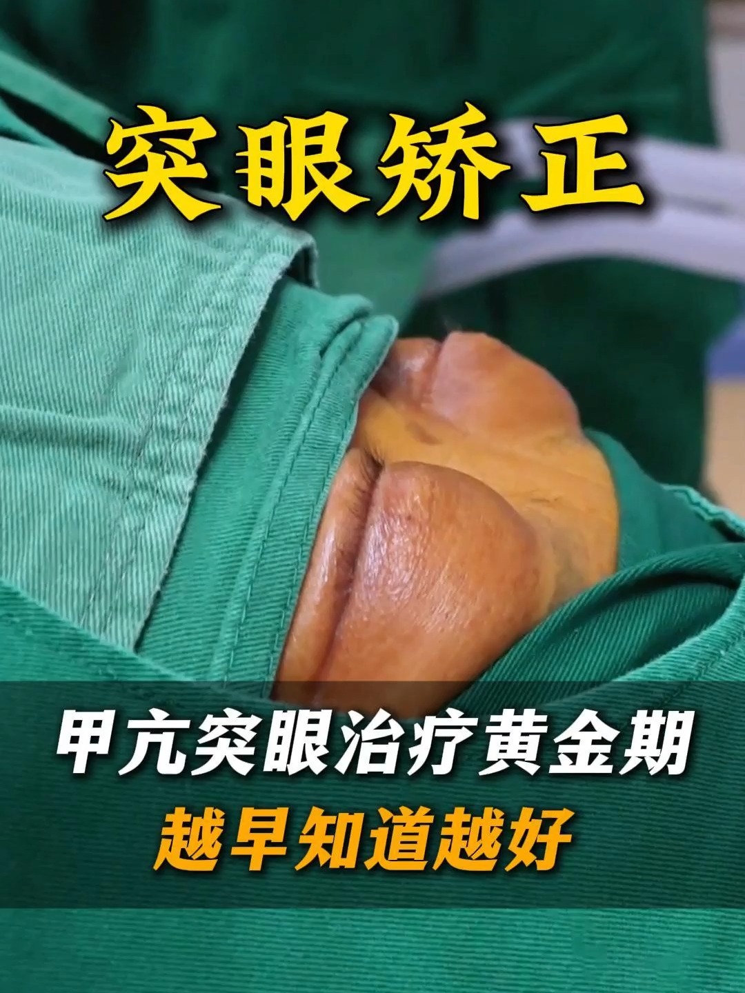 甲亢突眼的最佳恢复期