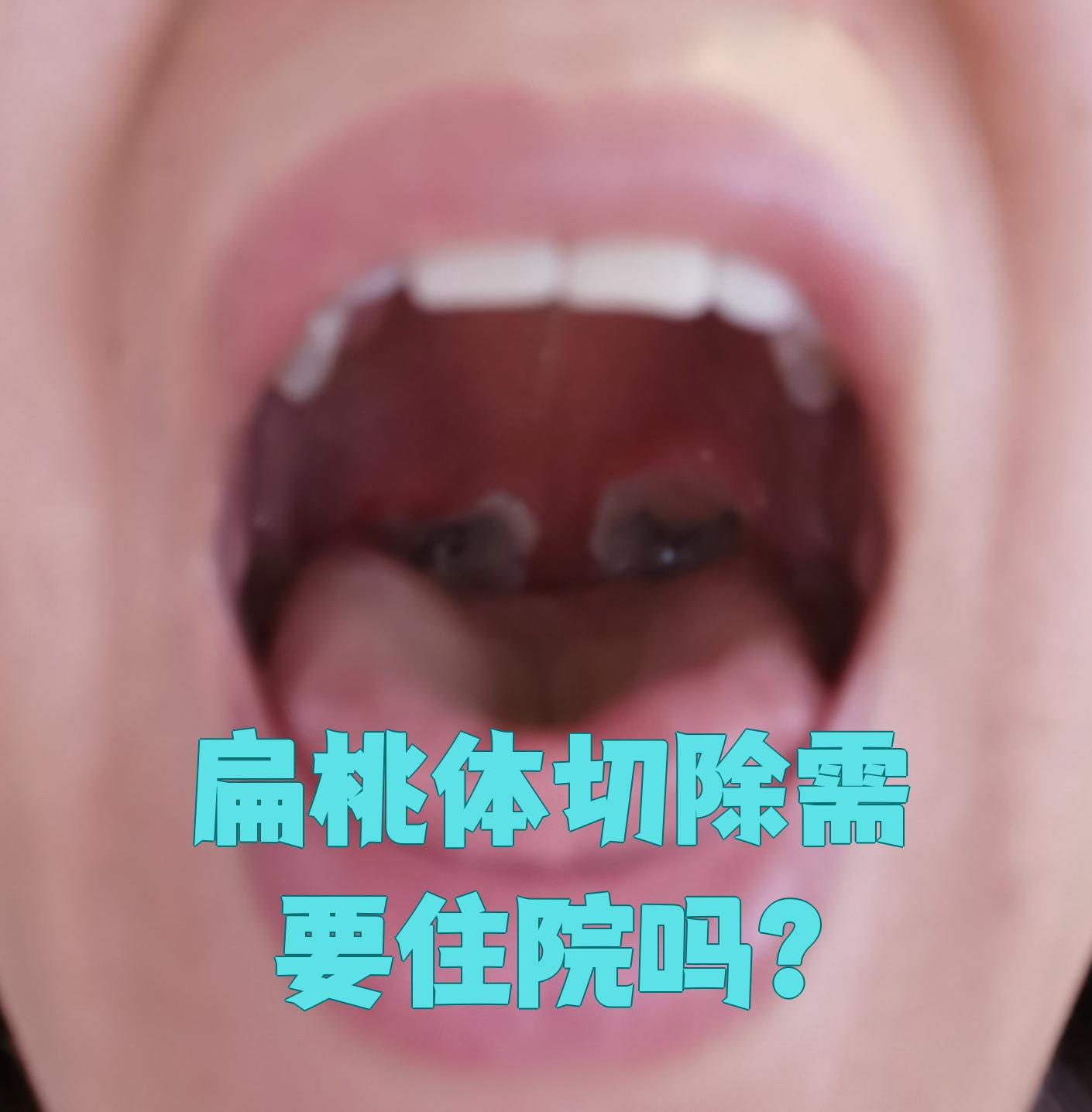 扁桃体切除手术疼吗?