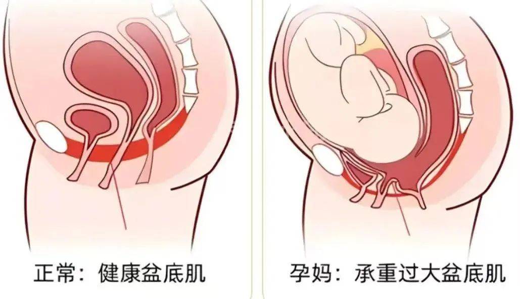 顺产阴道松弛怎么办,