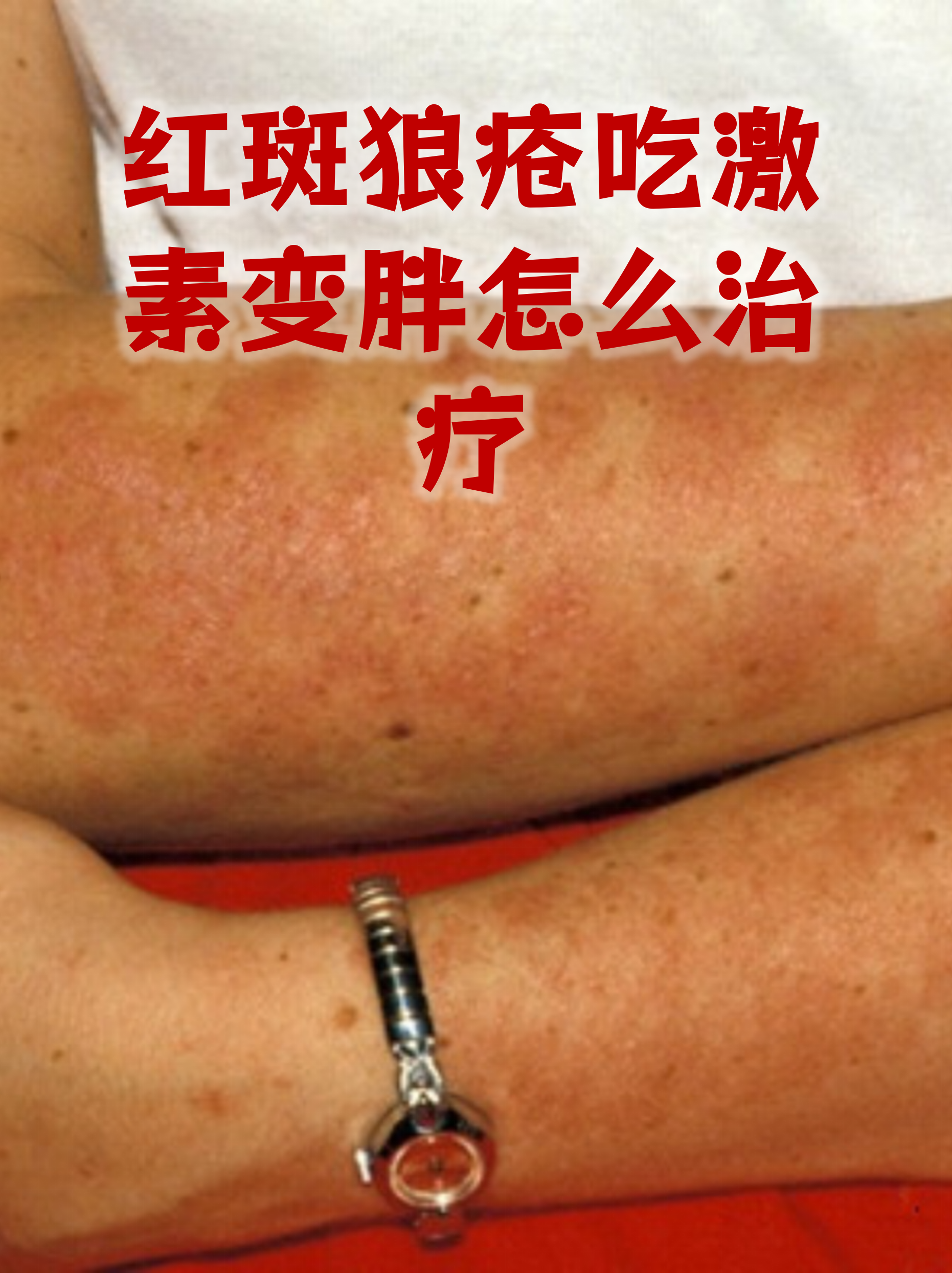 红斑狼疮治疗费用贵吗