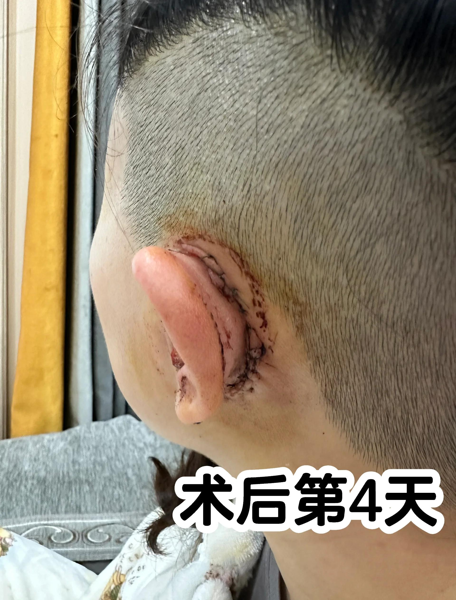 中耳胆脂瘤手术危险吗?