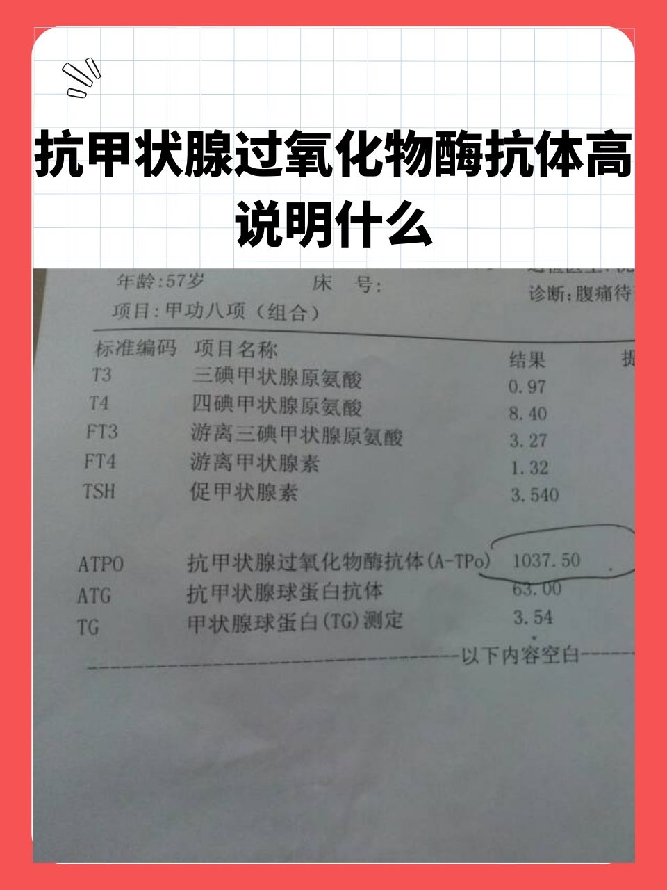 甲状腺抗体偏高怎么治疗