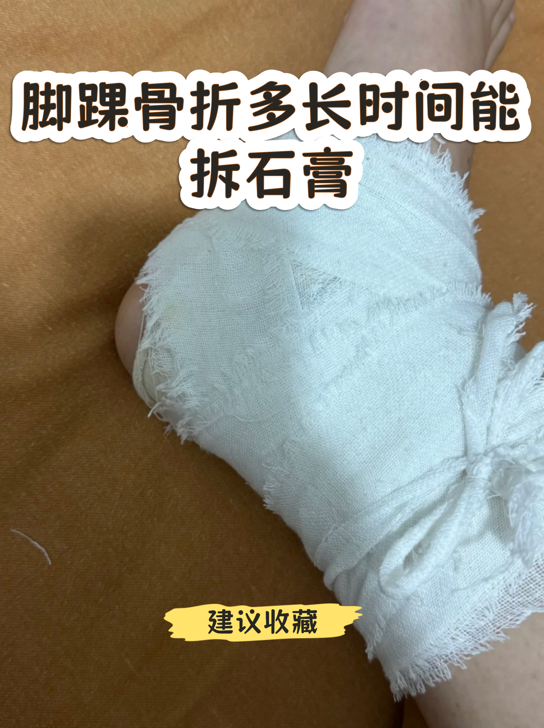 骨折打石膏多长时间可以拆?