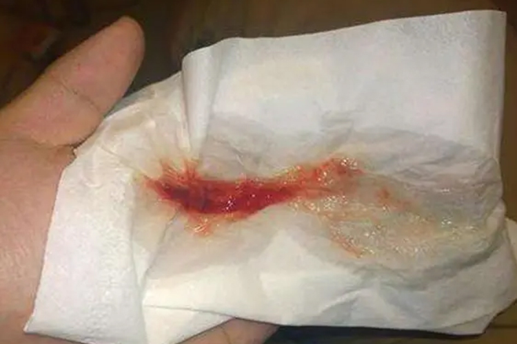 鼻涕里有血丝是怎么回事?