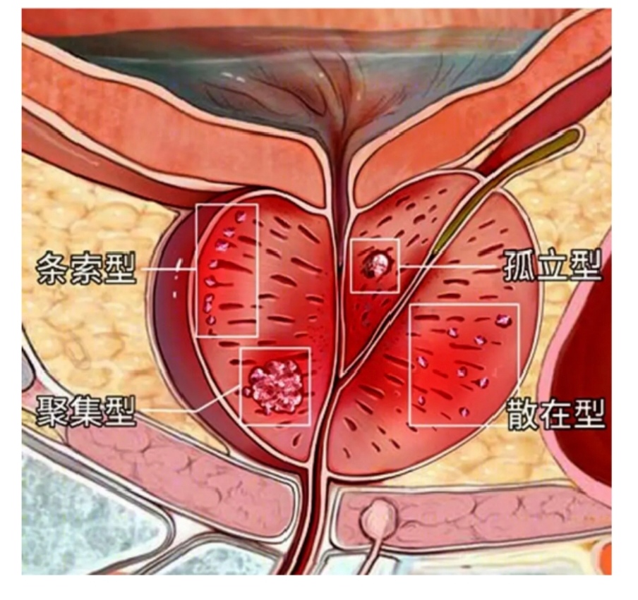 前列腺钙化灶要紧吗??