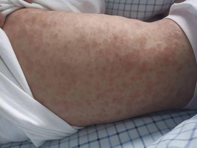 阿莫西林过敏的症状是什么