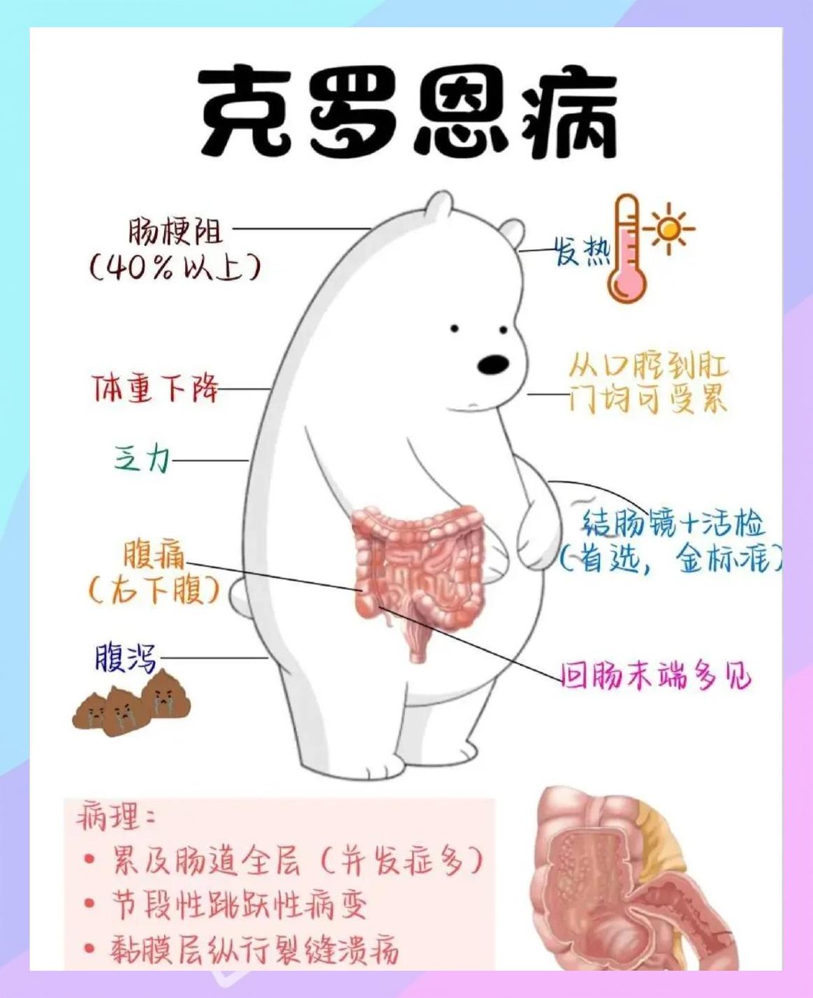 克罗恩病的平均寿命?