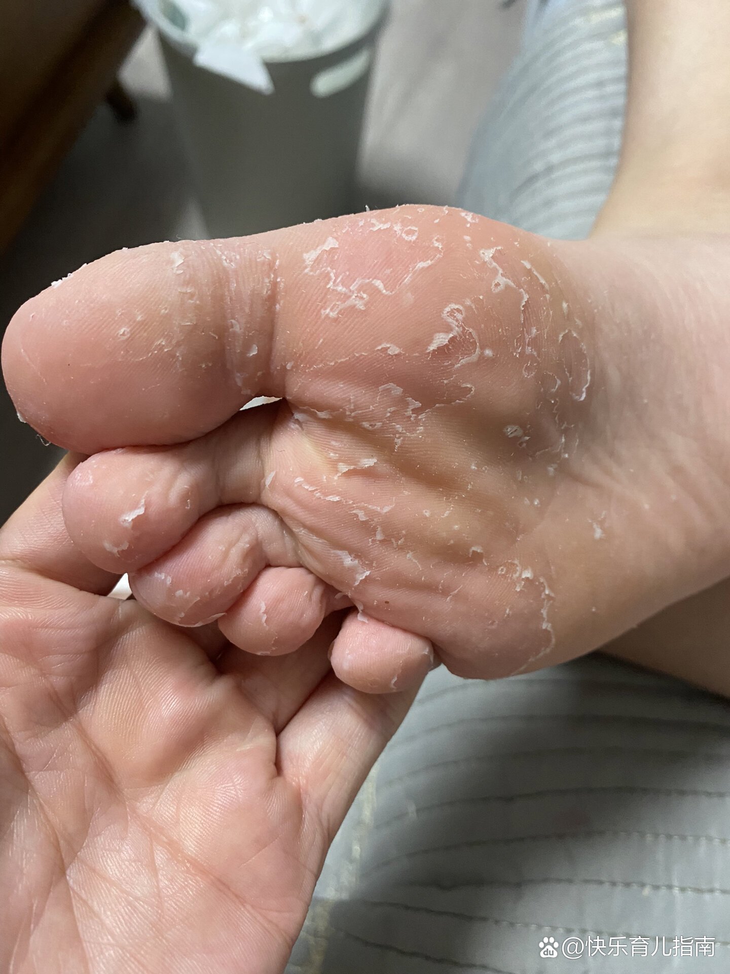 脚脱皮是怎么回事?