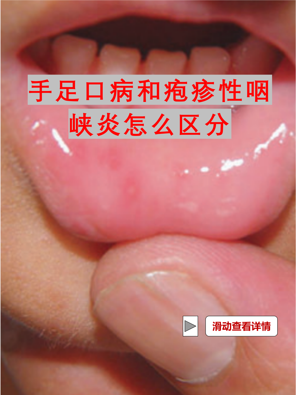 疱疹性咽峡炎传染吗