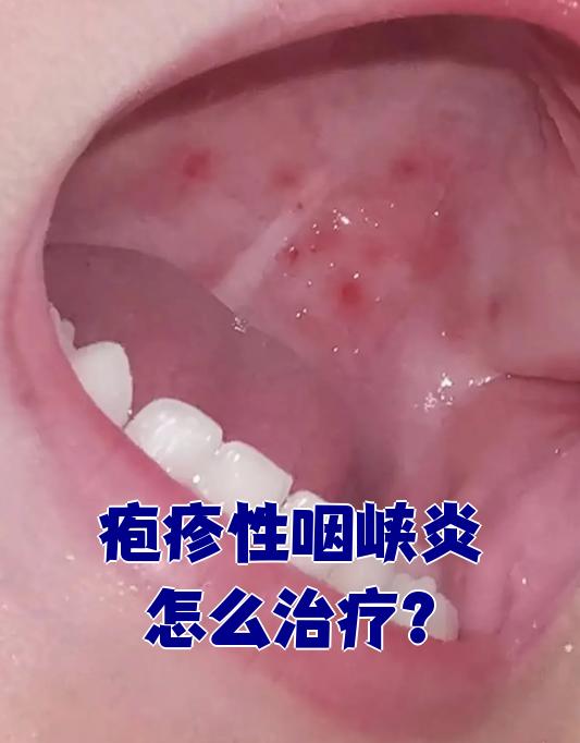 疱疹性咽峡炎传染吗