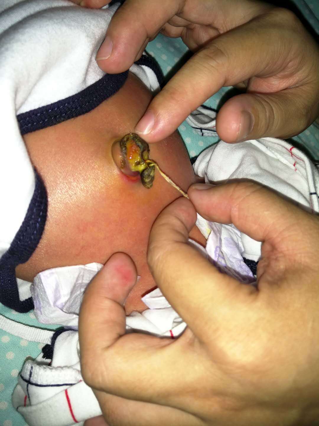 新生儿肚脐掉了有脓怎么回事