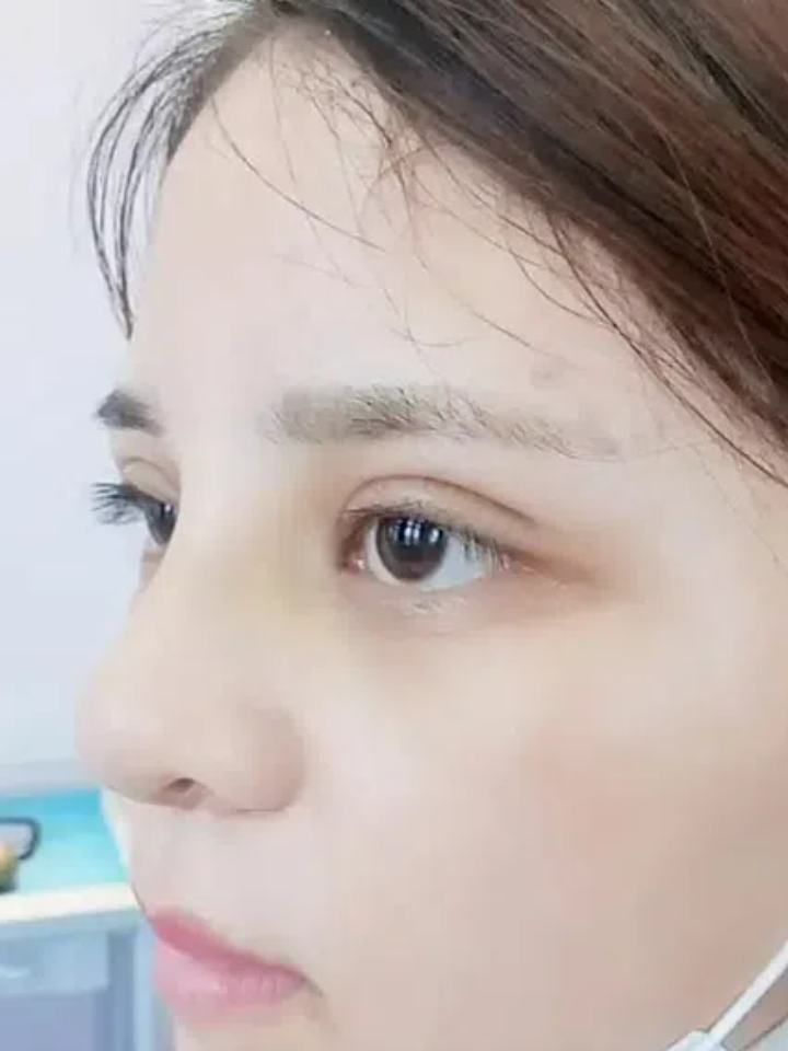 北京割双眼皮大概多少钱