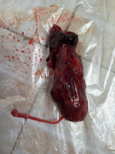 药流不干净的症状表现