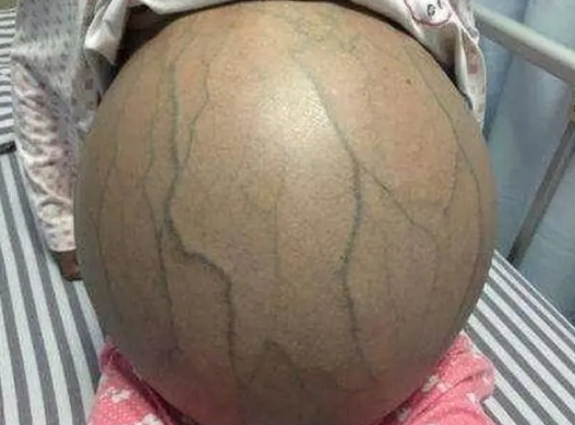 肝硬化腹水能活几年?