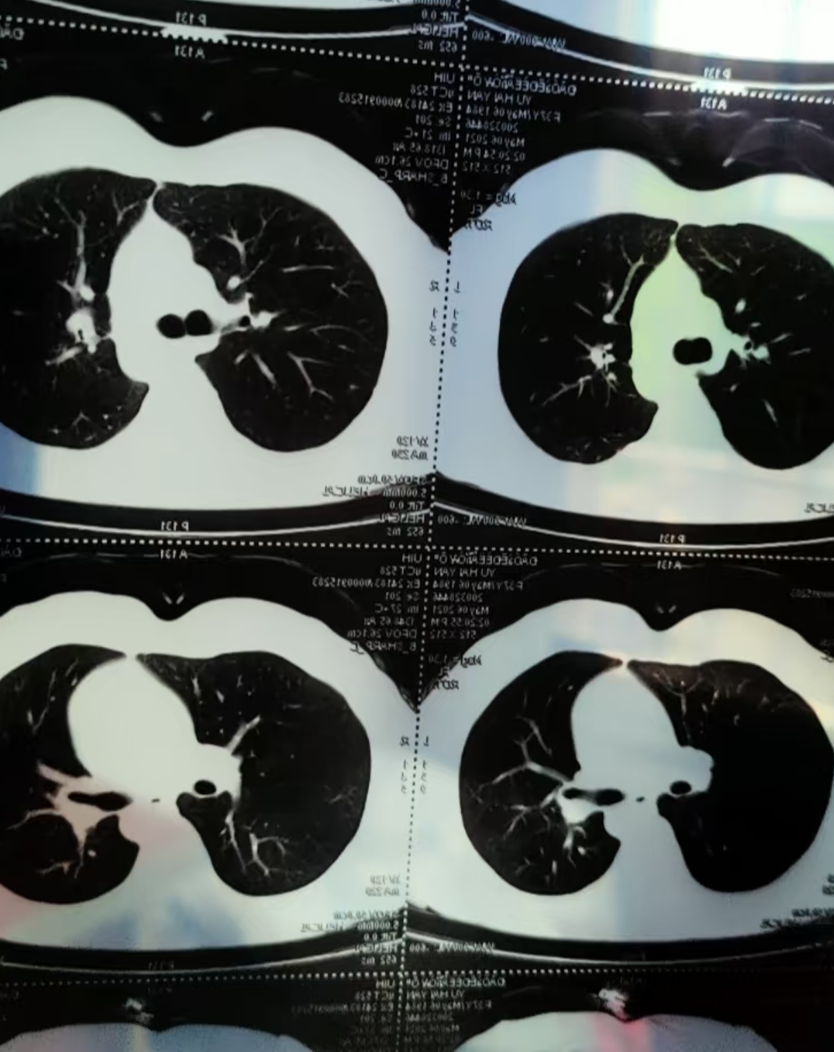 肺部有结节严重吗