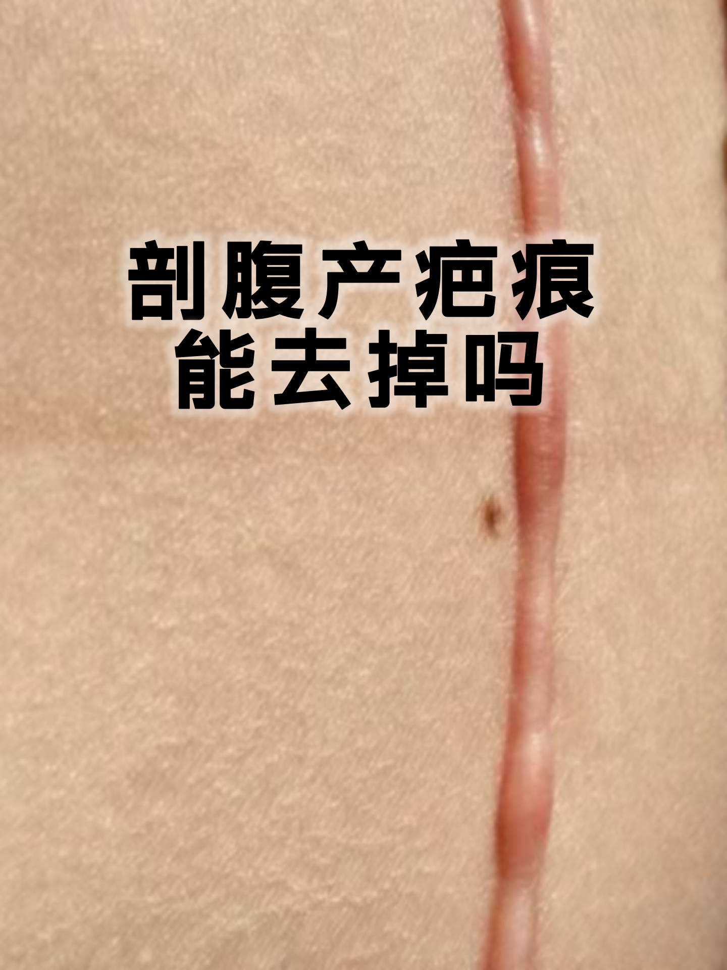 剖腹产后伤口多久可以碰水