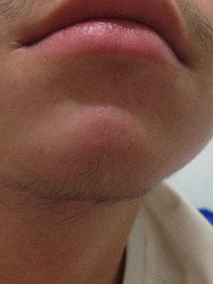 下巴长了个硬包,按着痛