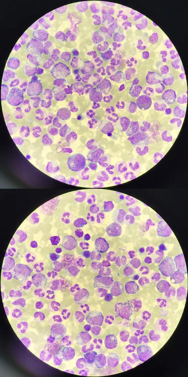 什么是慢性粒细胞白血病?