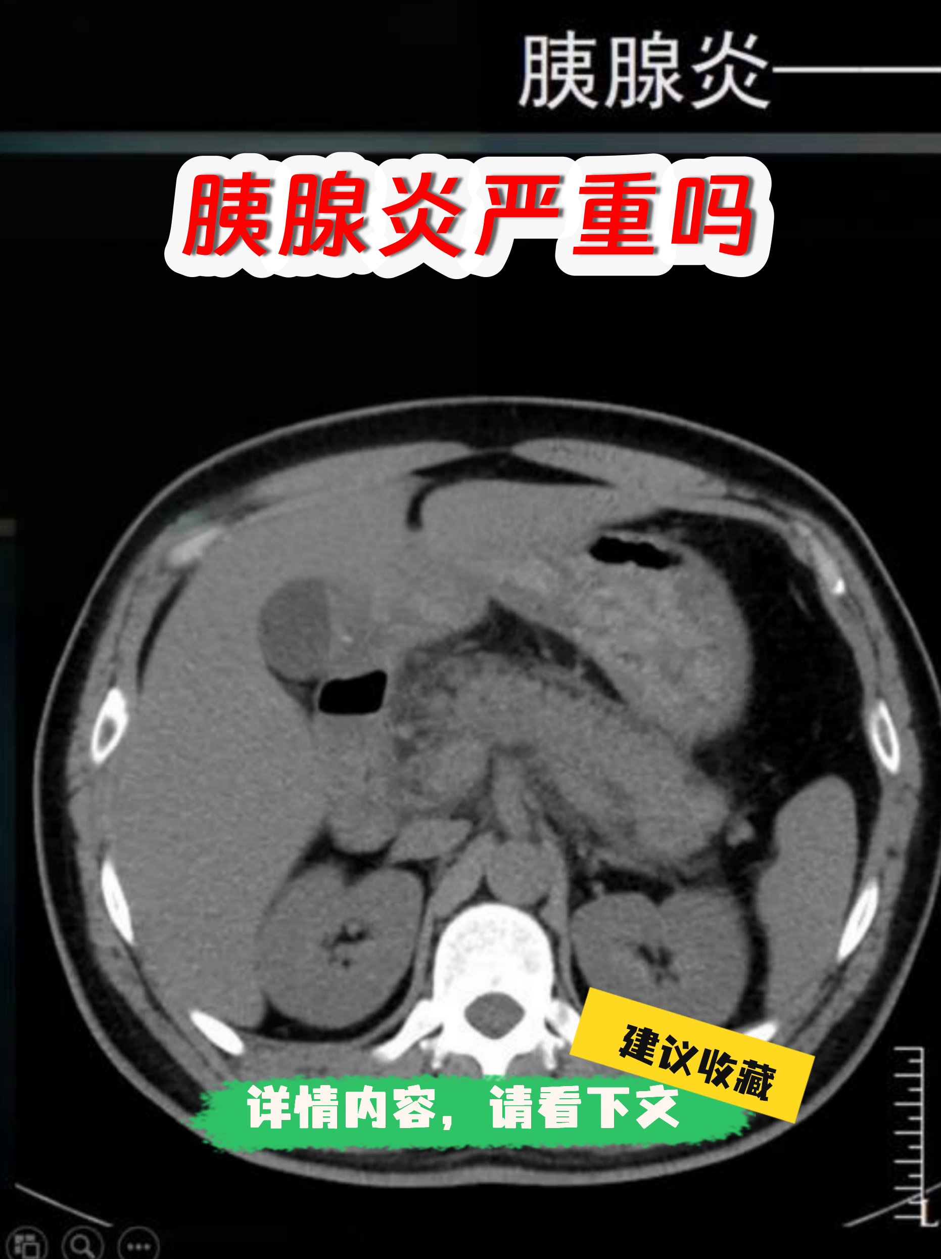 怎么检查胰腺炎
