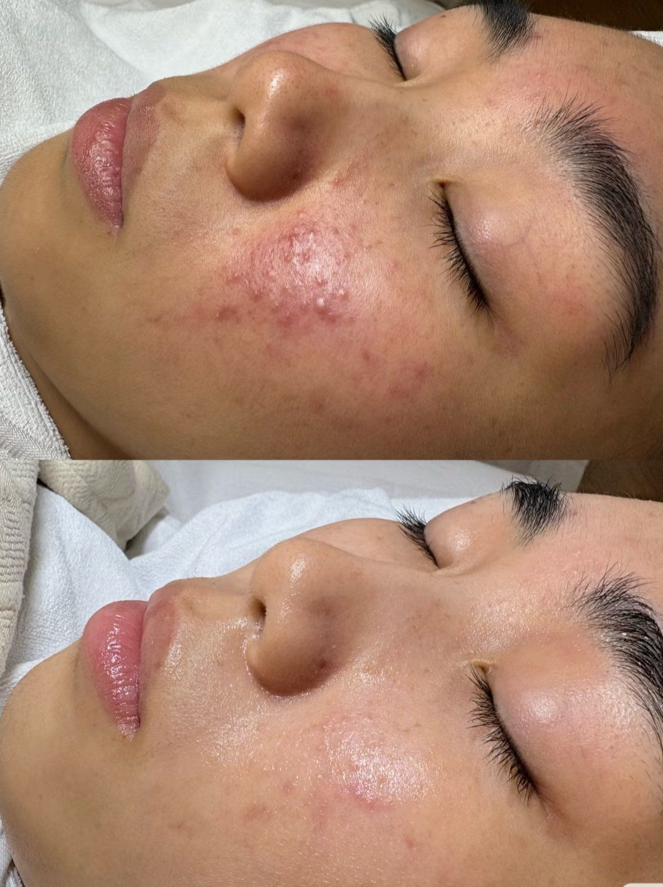 激素脸可以自己修复吗