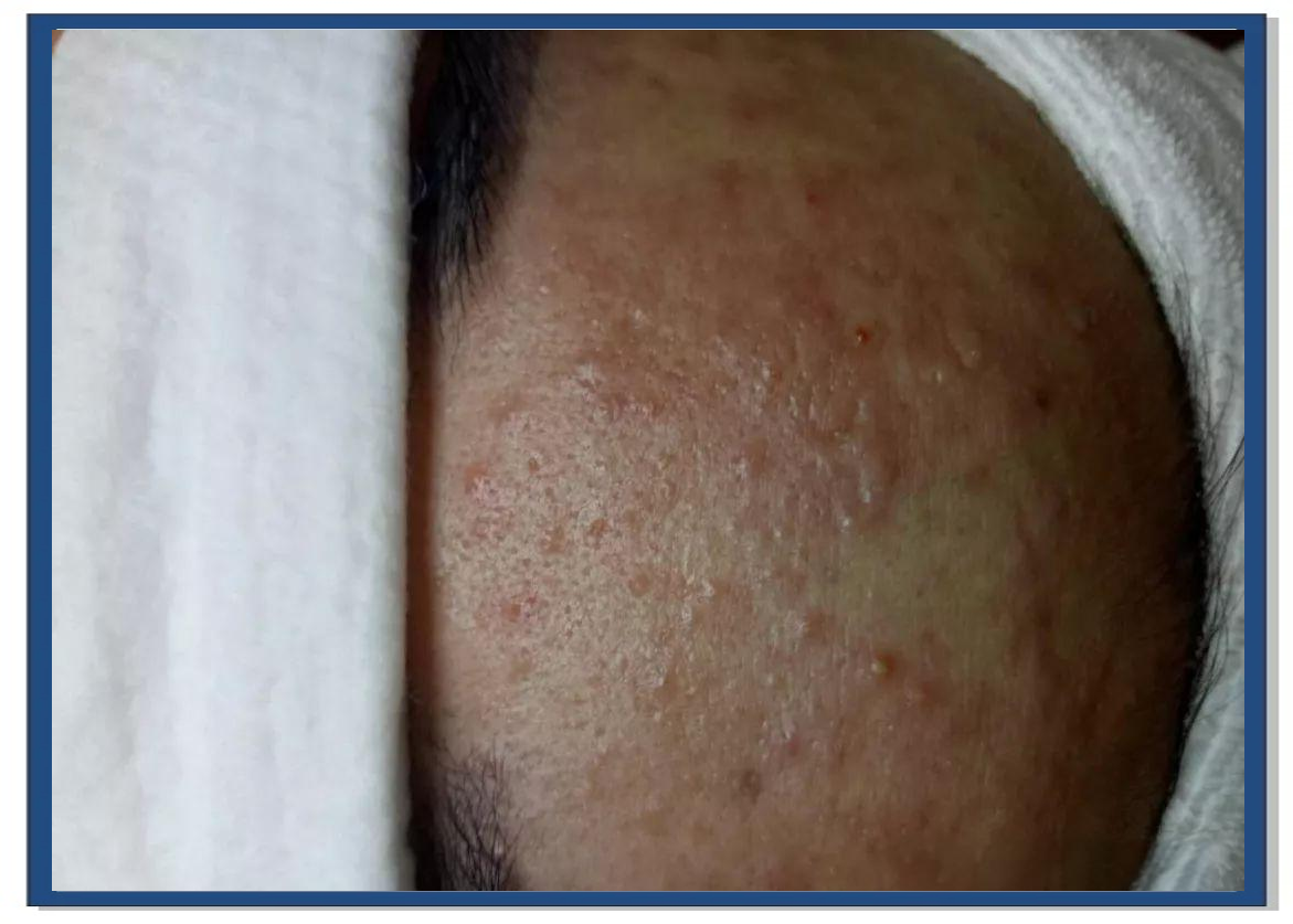 激素脸可以自己修复吗