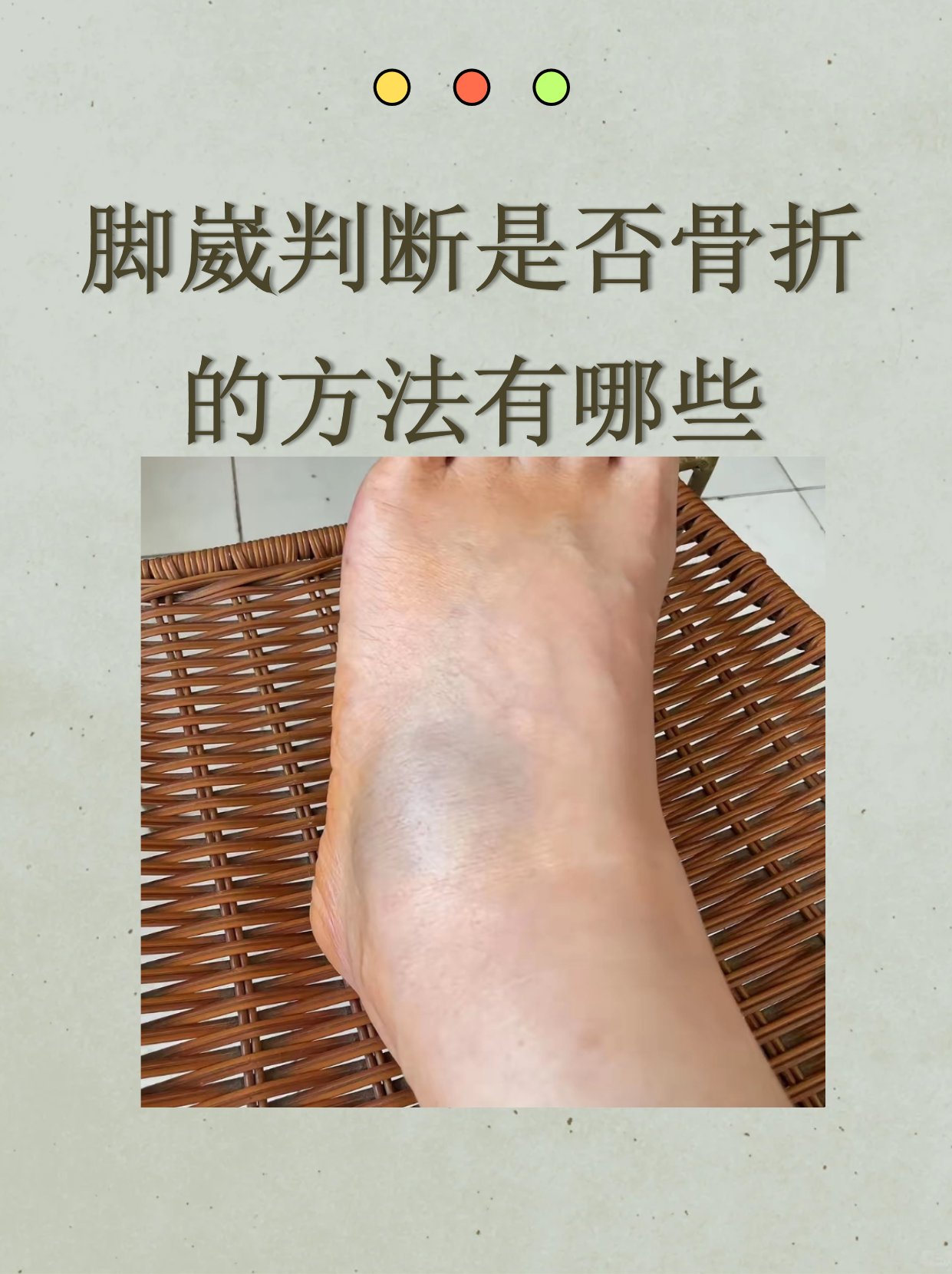 脚扭伤多长时间能恢复