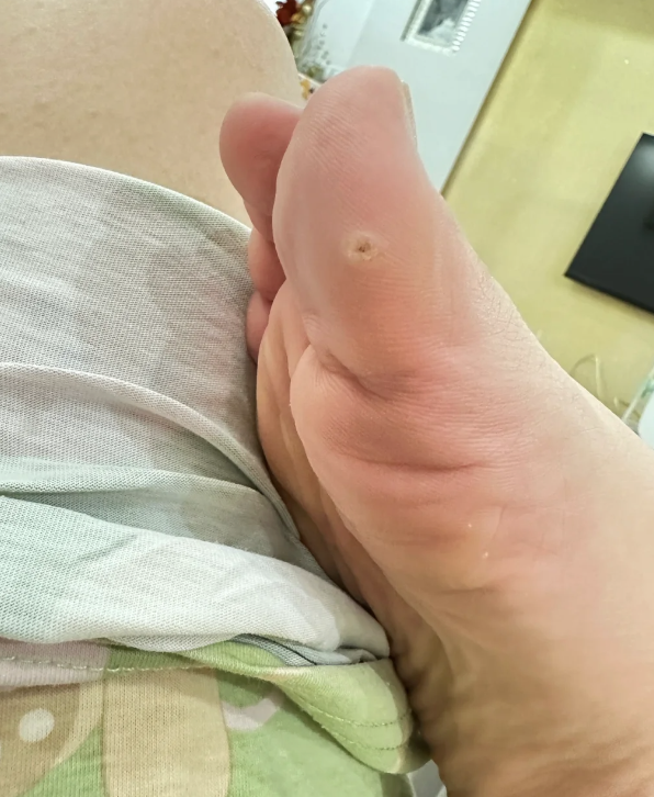 鸡眼初期怎么治疗啊