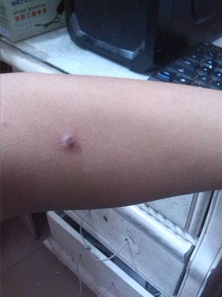 胳膊上长了个硬疙瘩,不痛