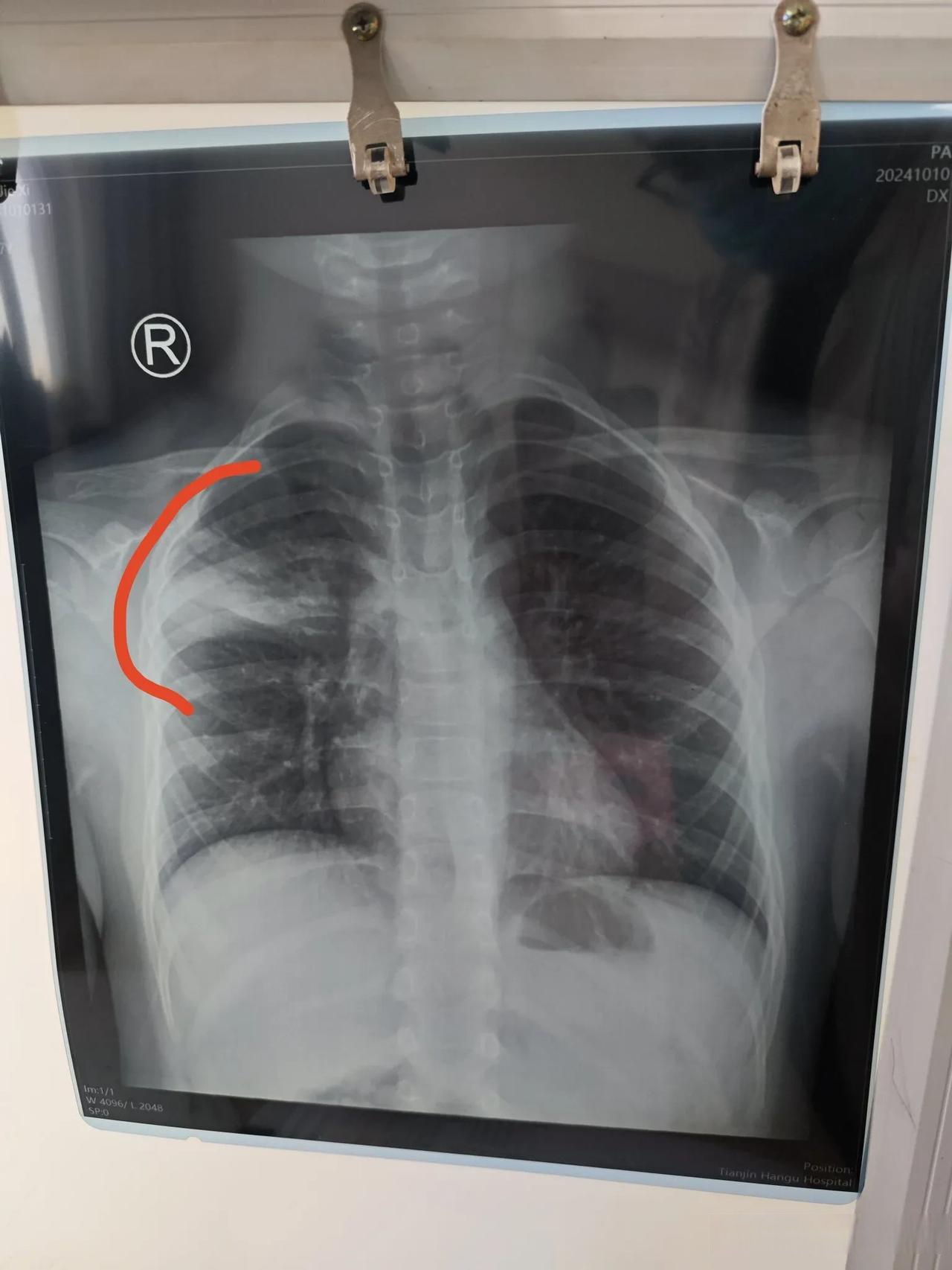 肺部有阴影是什么病