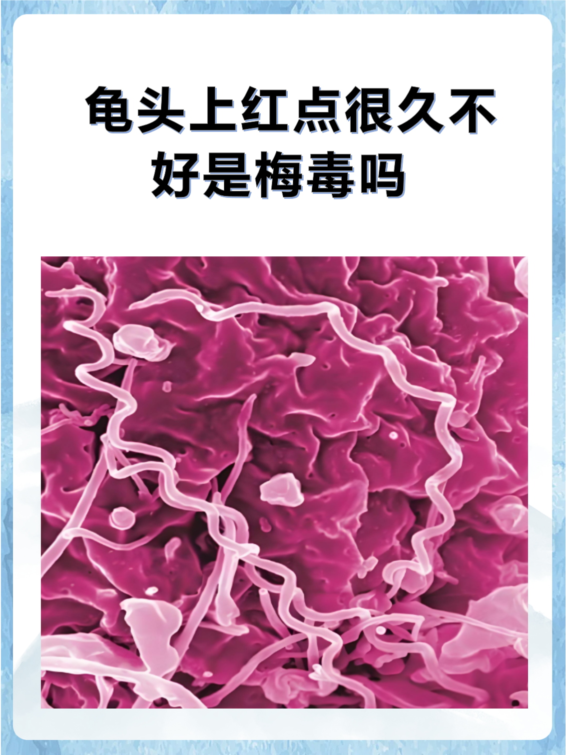 梅毒滴度多少是算正常?