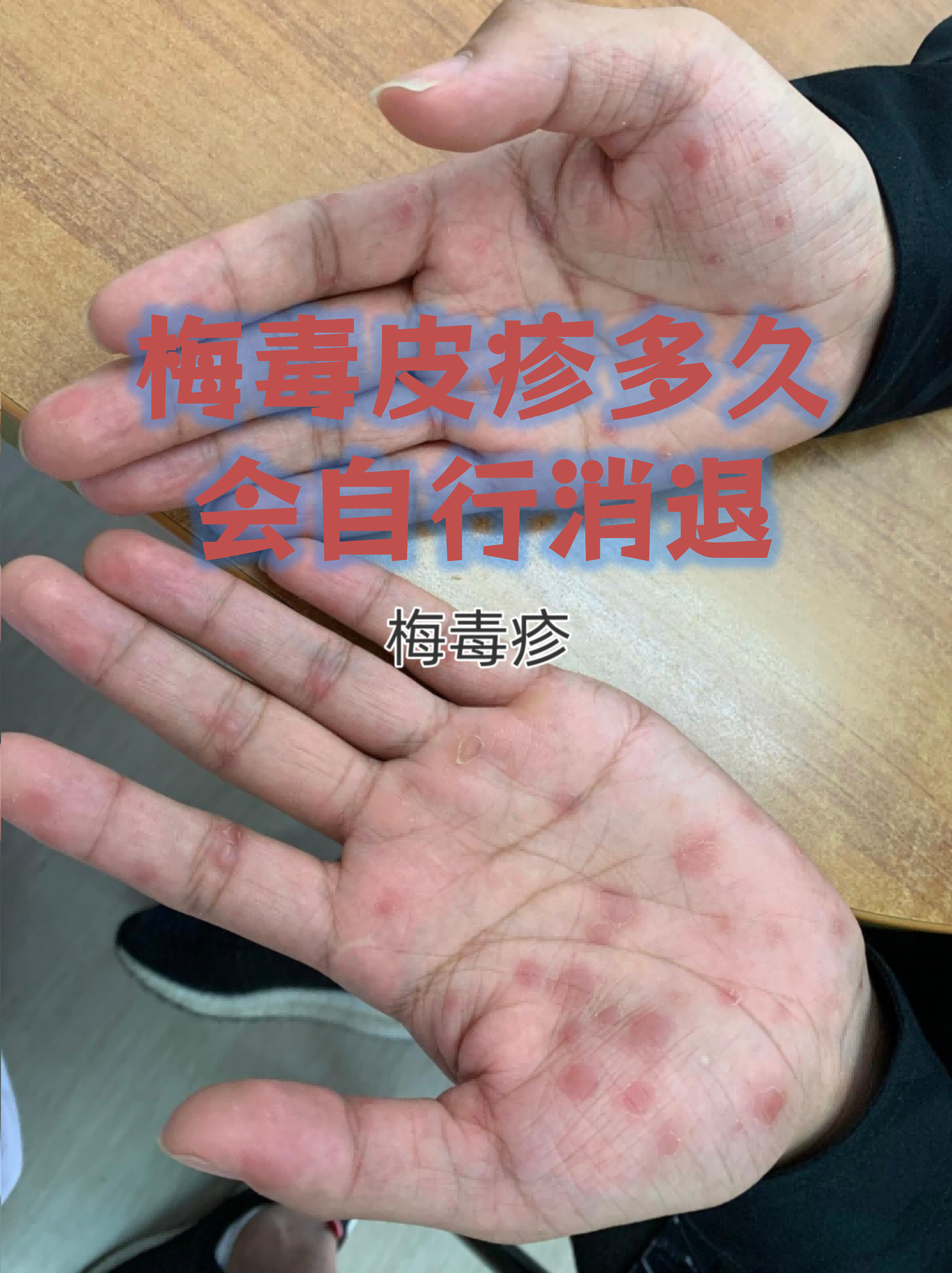 梅毒滴度多少是算正常?