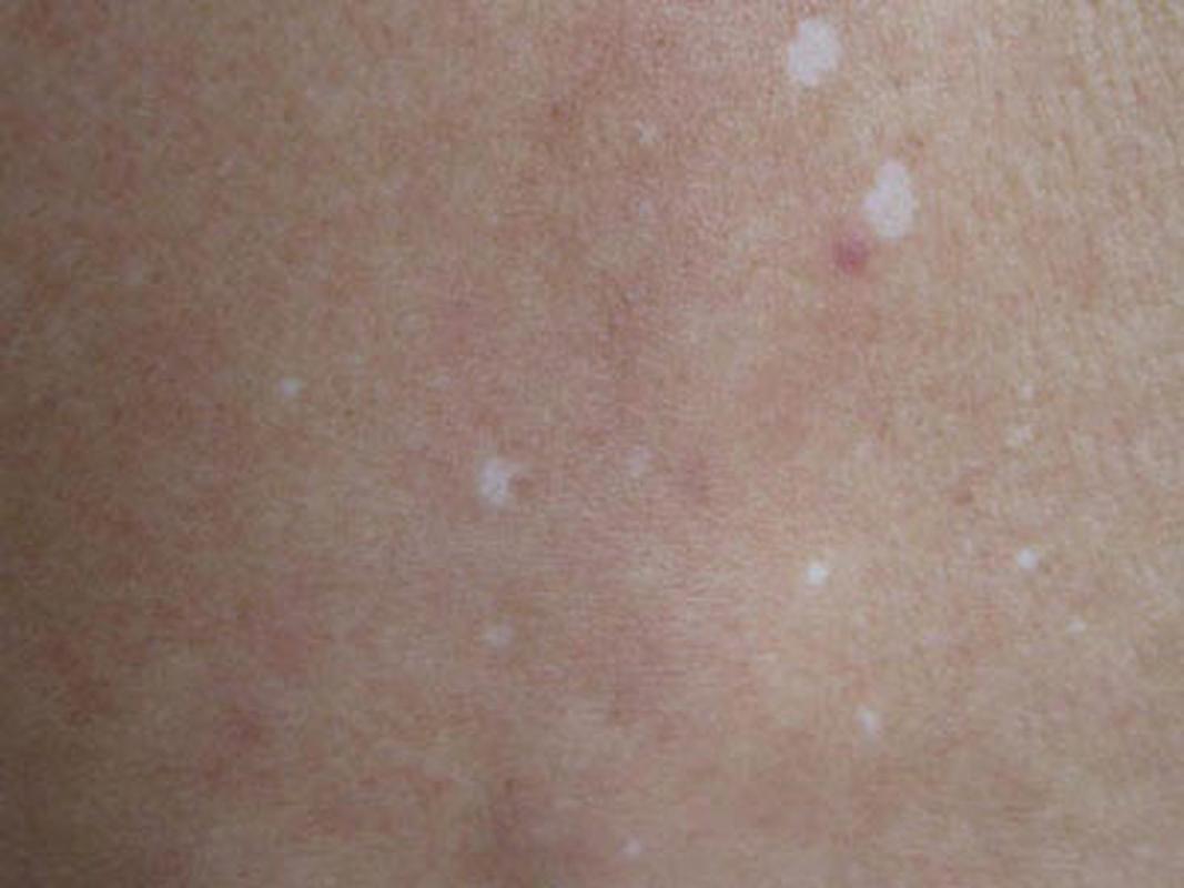 白斑的症状有哪些啊