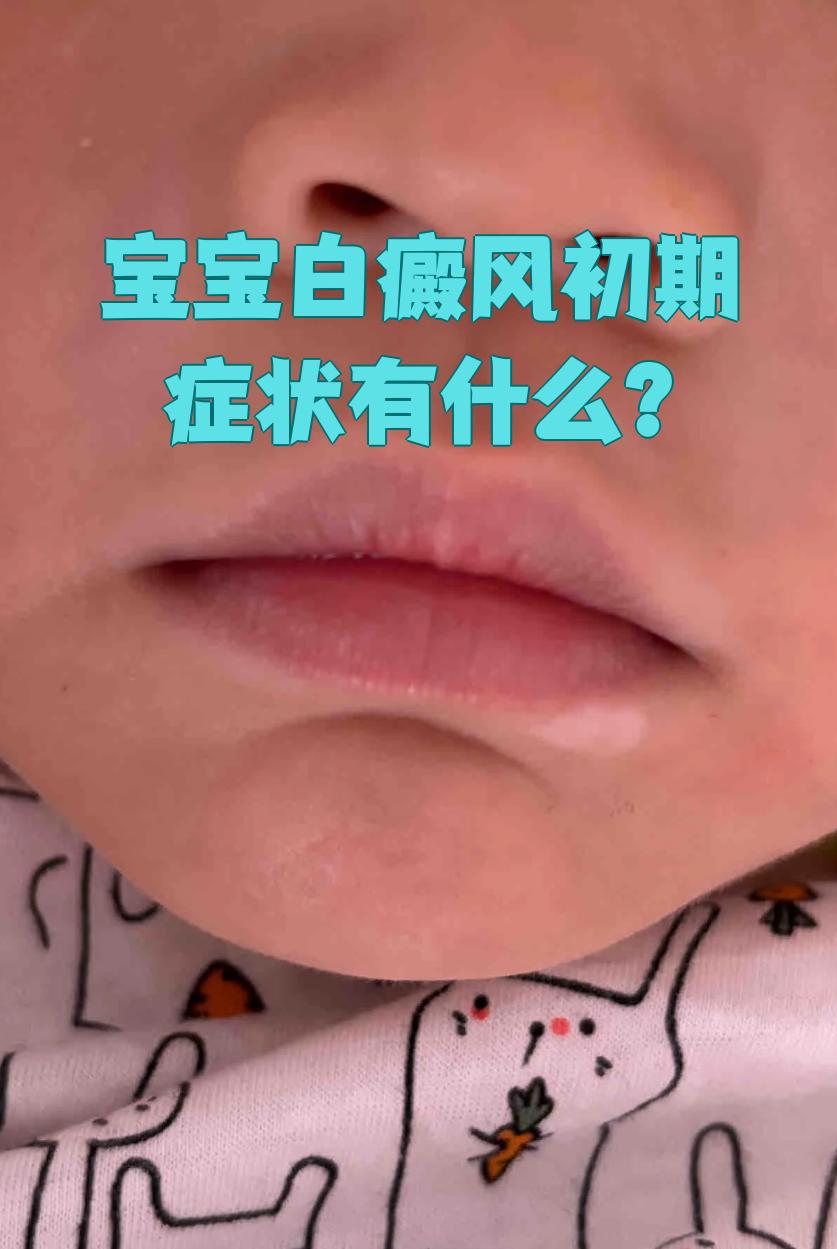 白斑的症状有哪些啊