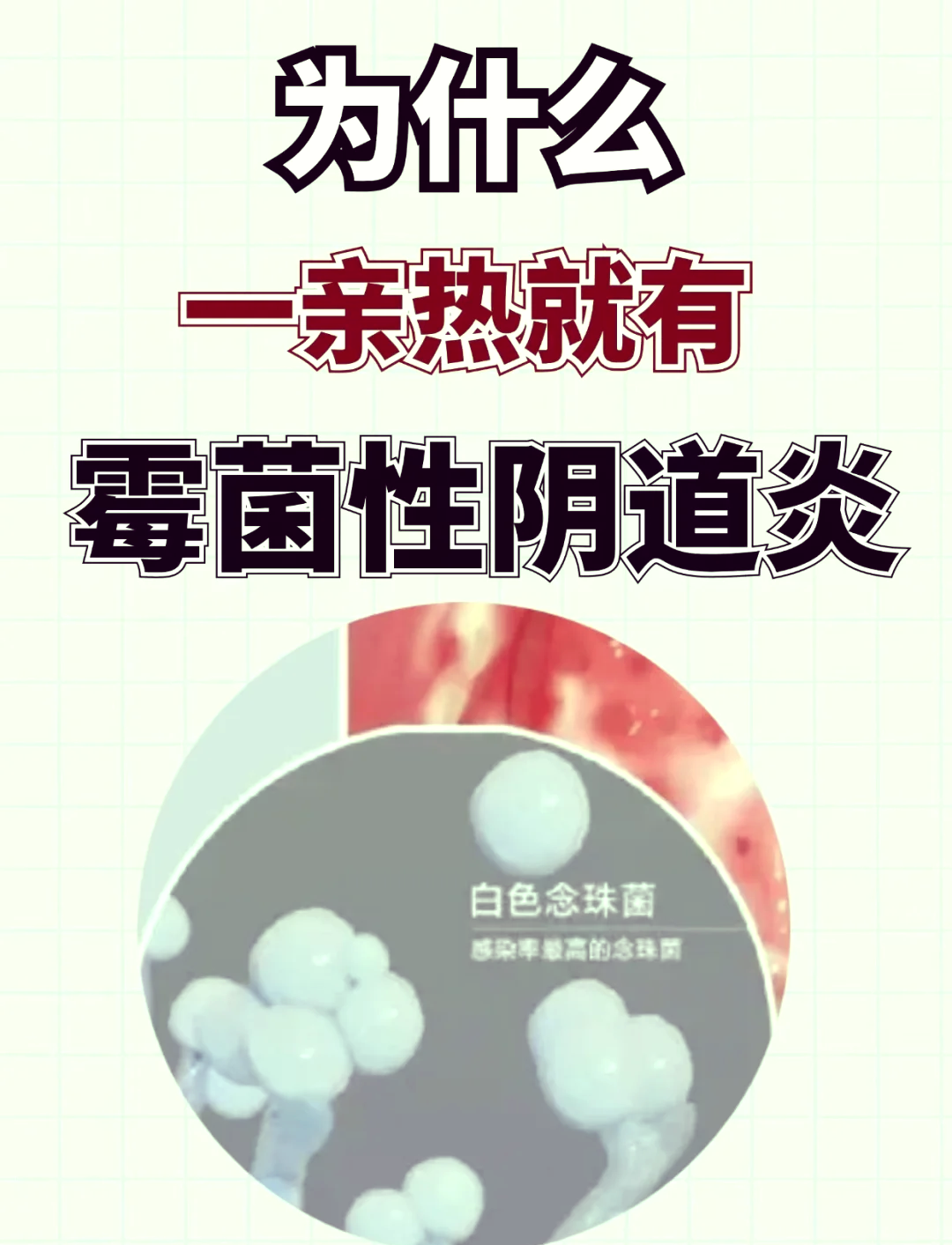 念珠菌性阴炎能根治吗