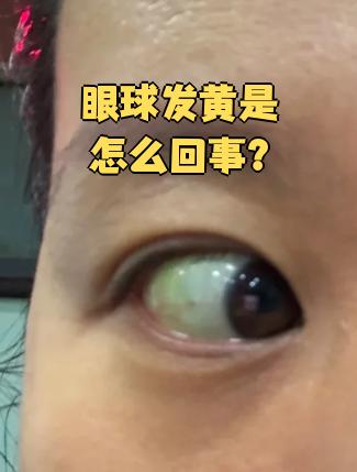 眼珠里发黄,是怎么回事