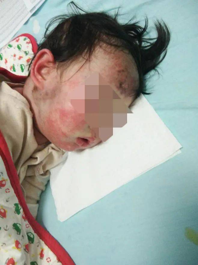 皮肌炎能治好吗