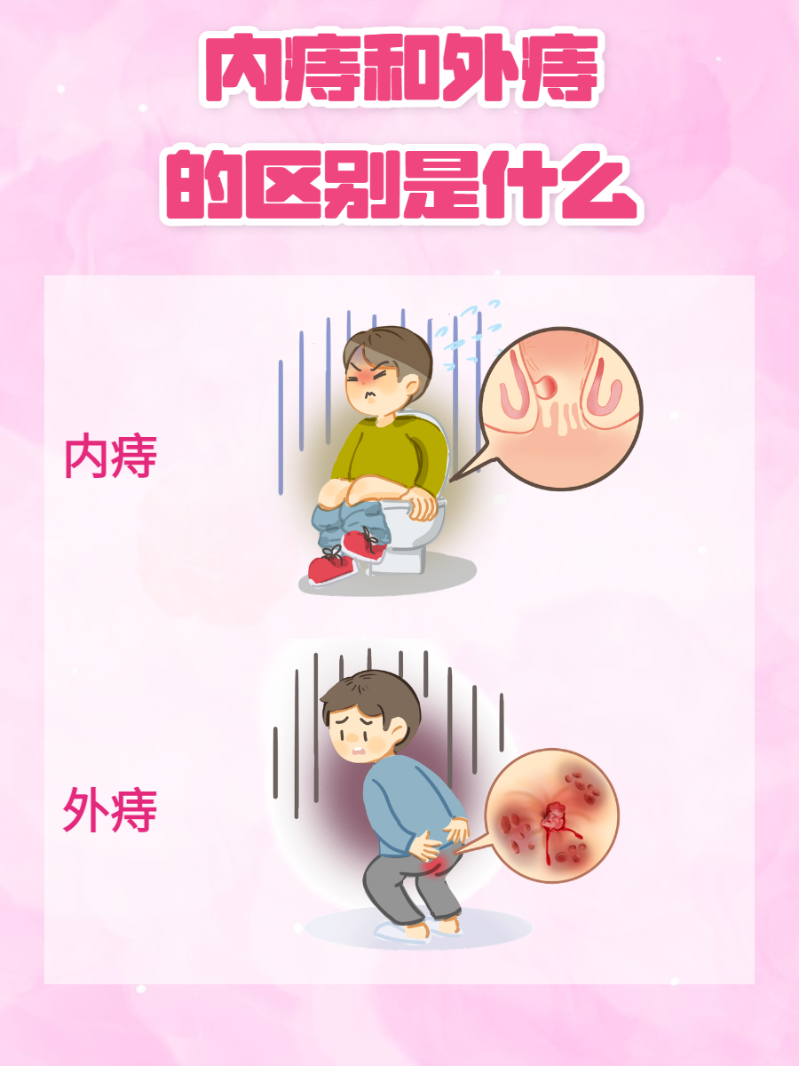 肛裂和痔疮的区别有哪些