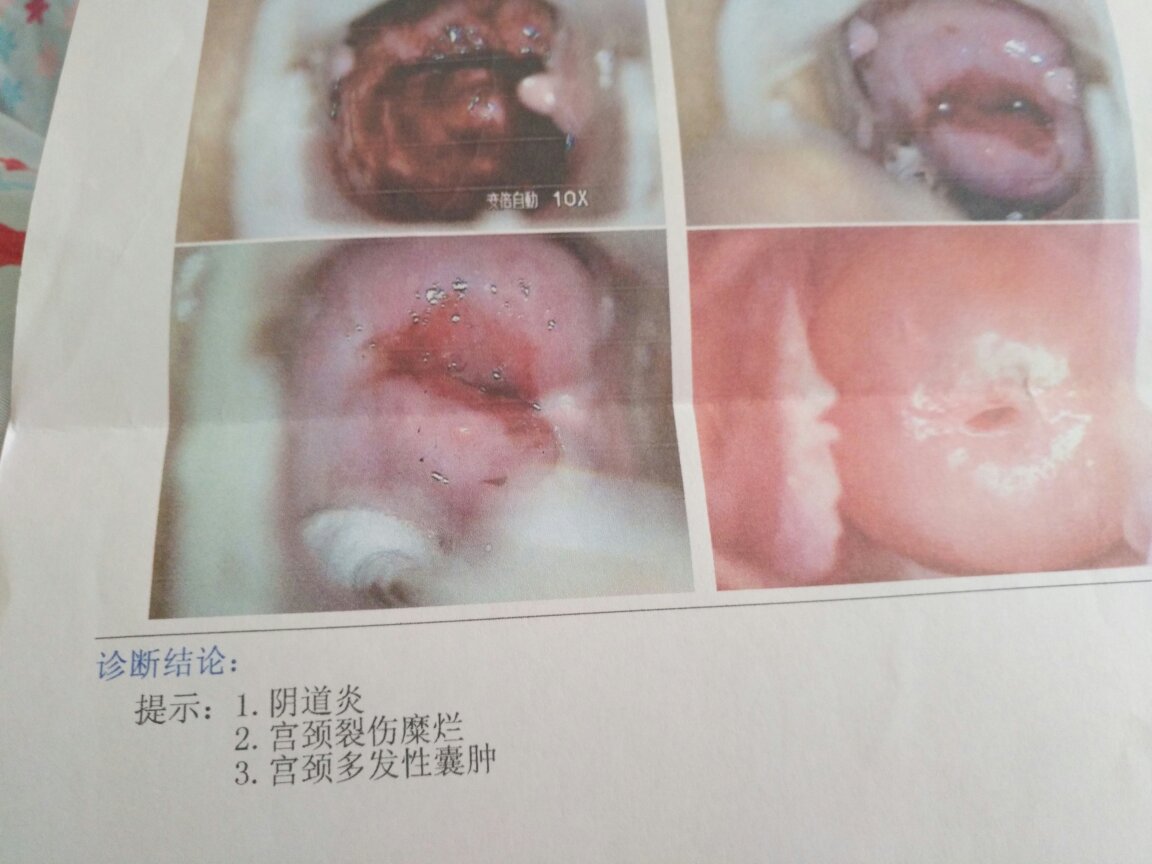 多发宫颈囊肿会自愈吗