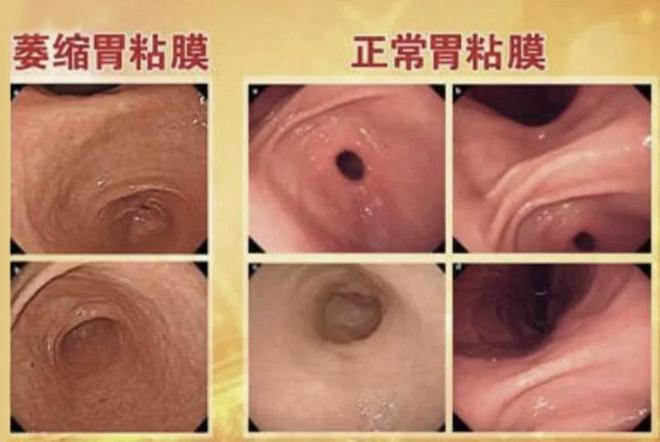 慢性胃炎伴糜烂会癌变吗