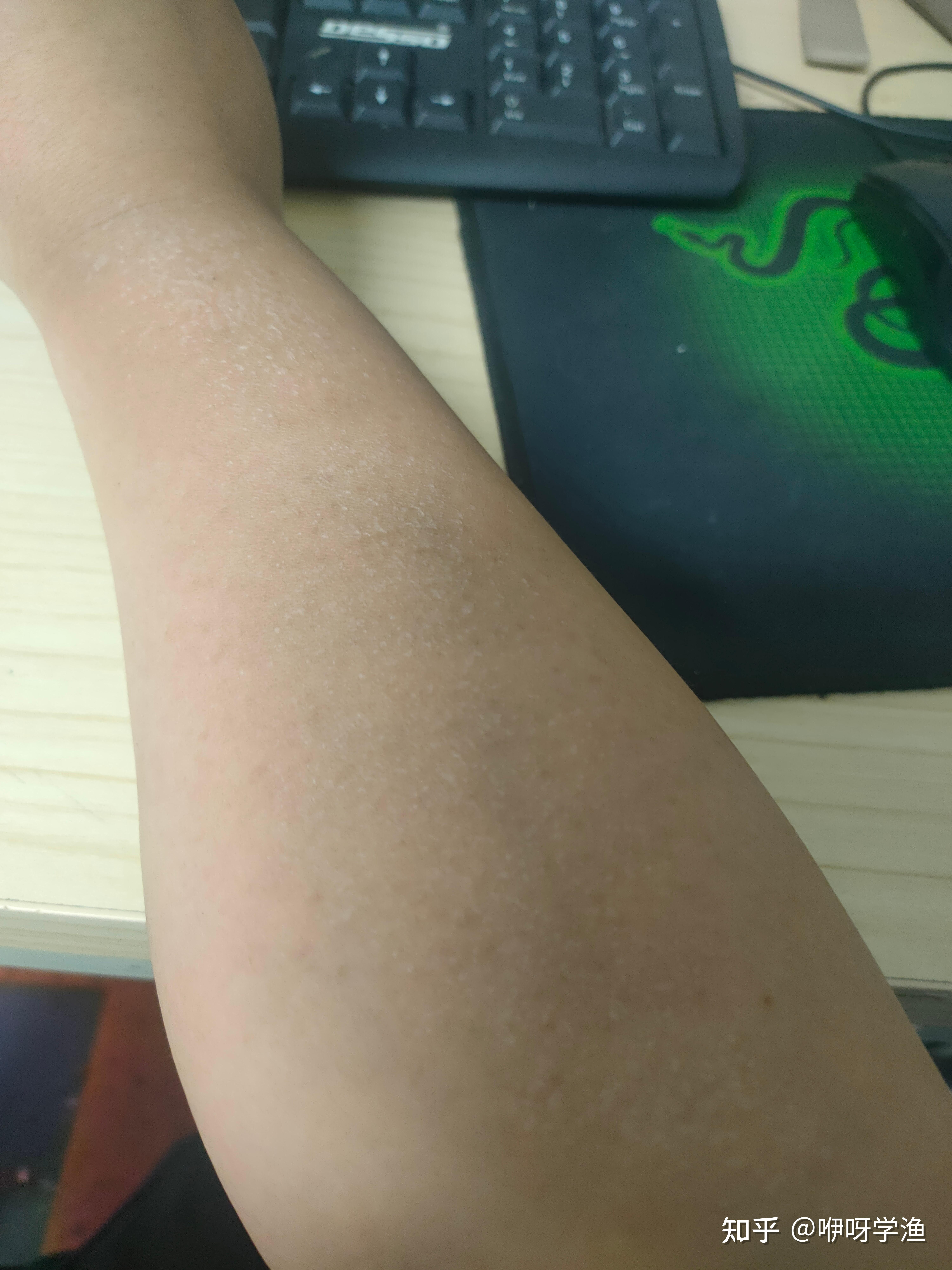 胳膊上有的地方很干燥还起皮