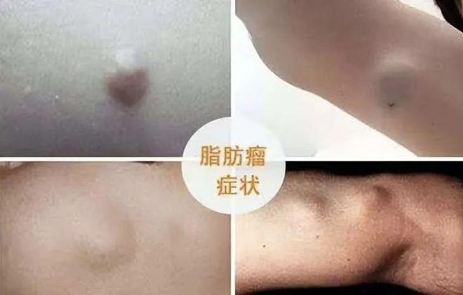 皮下脂肪瘤会癌变吗