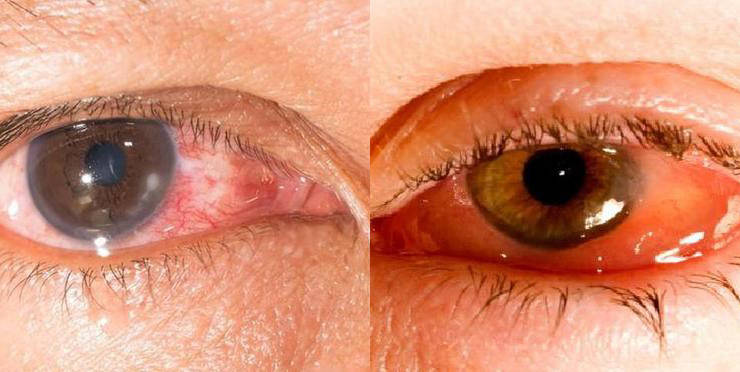 糖尿病并发症有哪些