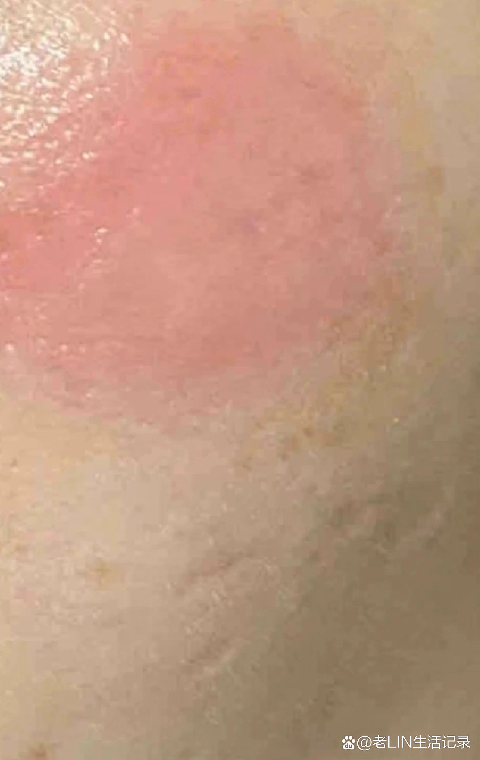 过敏性皮炎多久能好?