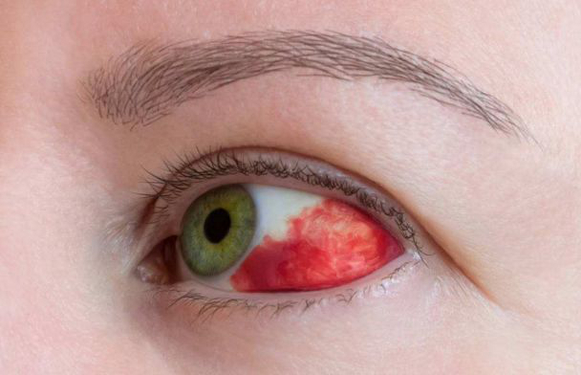 球结膜下出血能治好吗