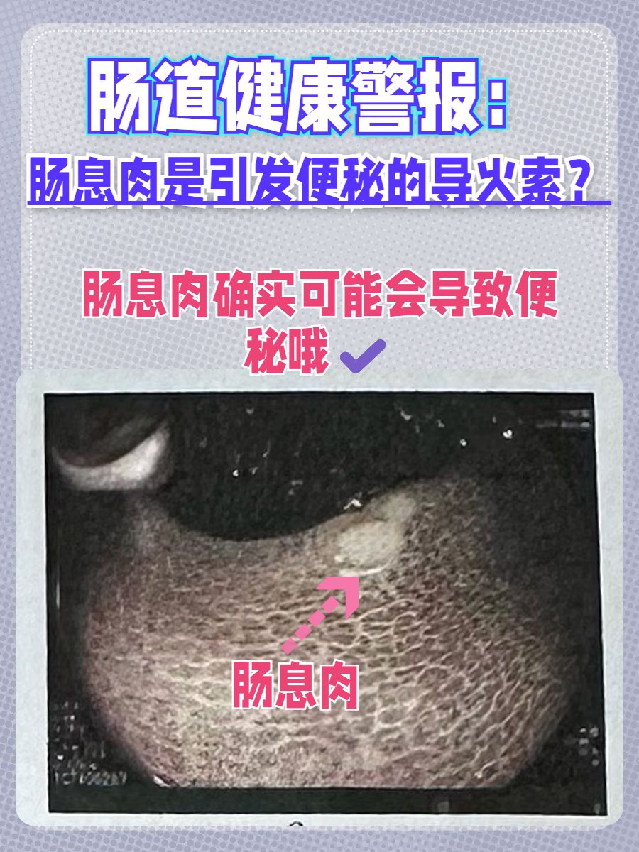 肠息肉会癌变吗?