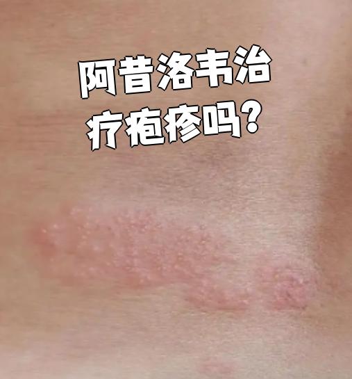 疱疹病毒是什么