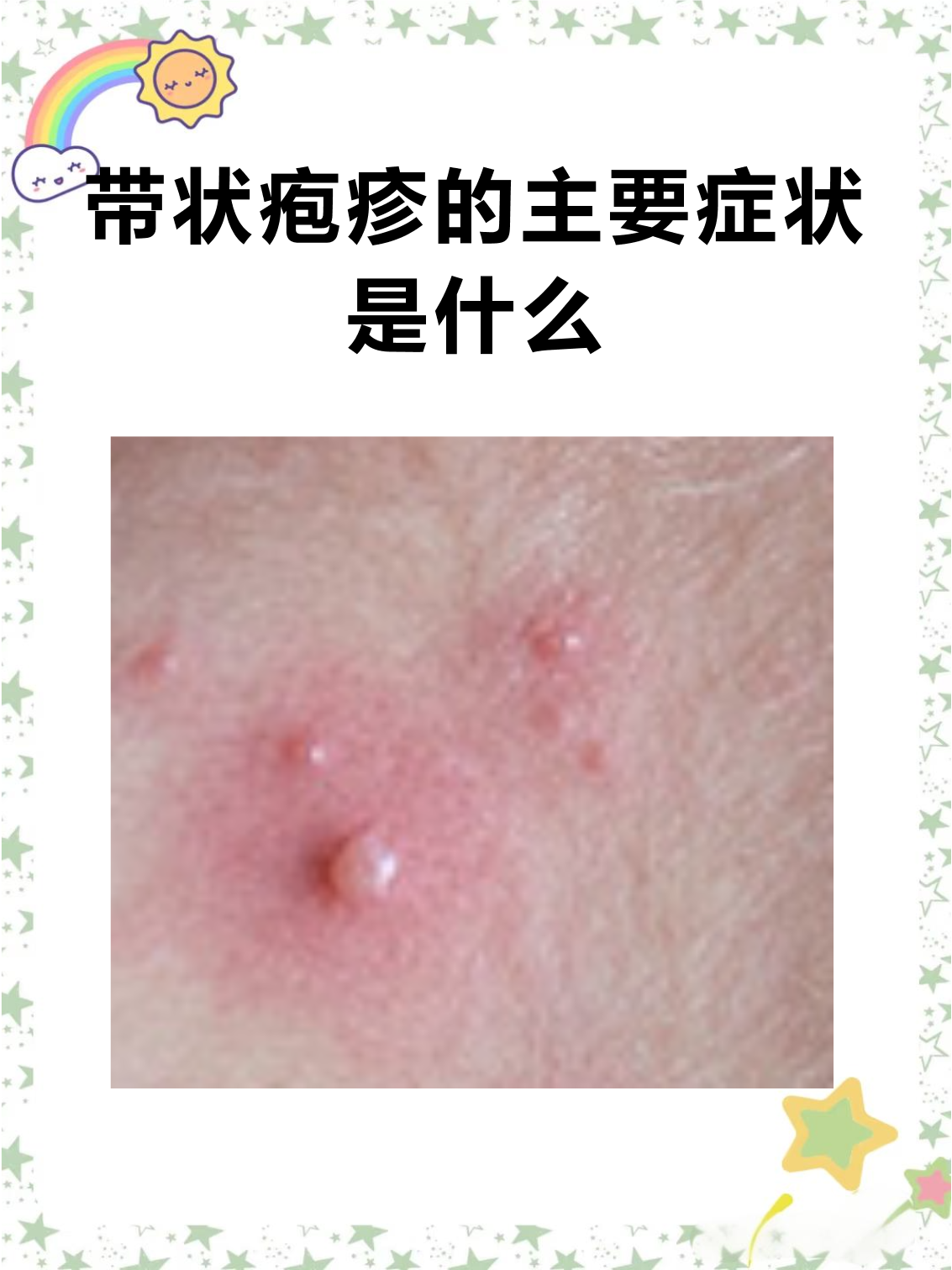 疱疹病毒是什么