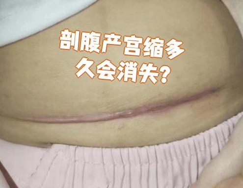 剖宫产手术是怎样的