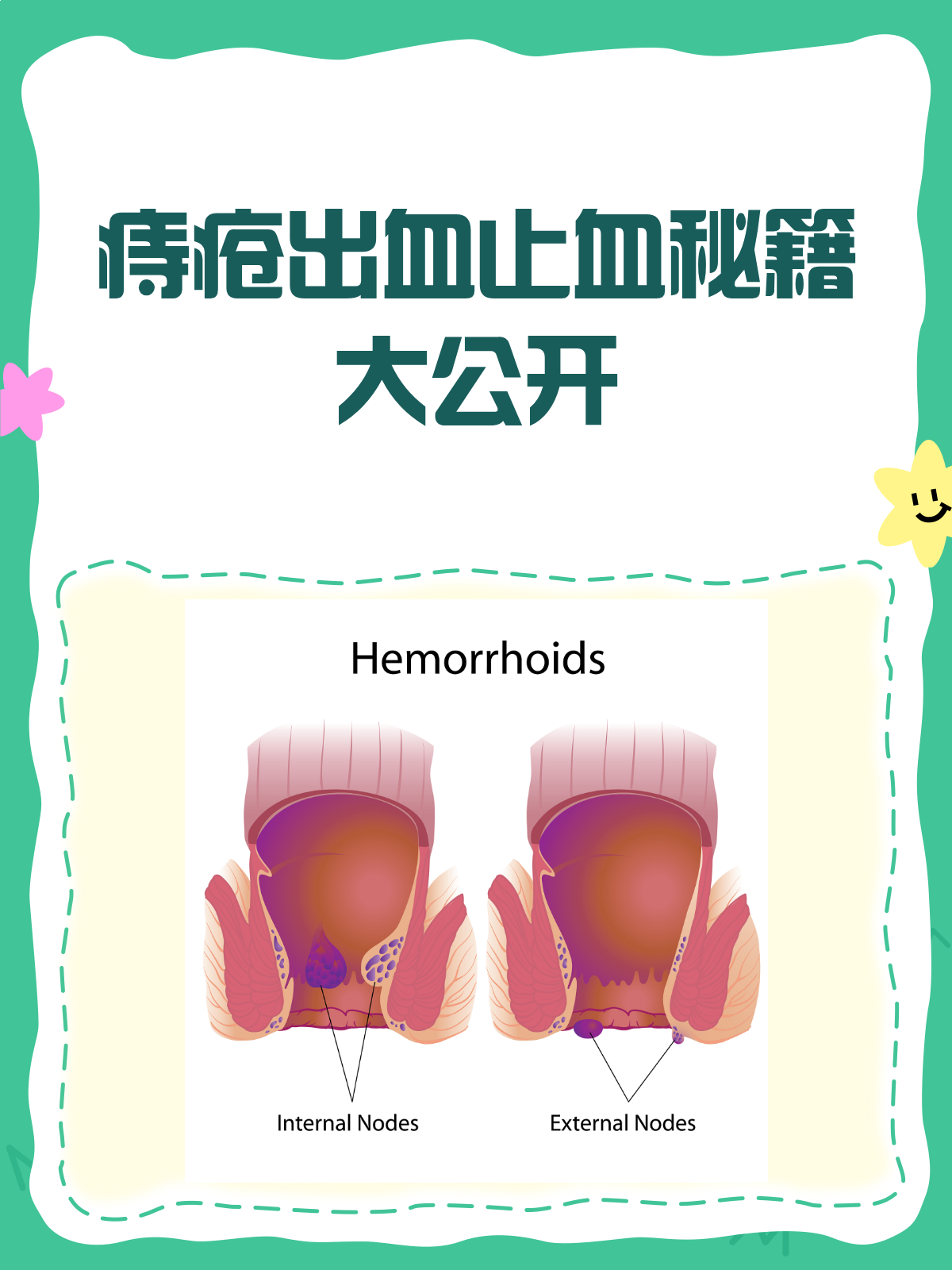 有痔疮出血怎么办?